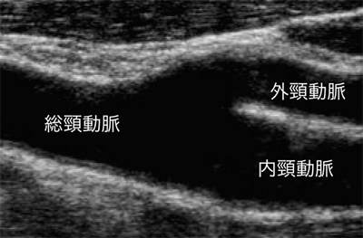 頸動脈超音波検査
